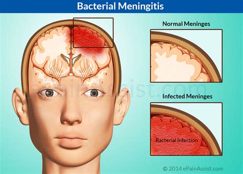 bacterial meningitis from ear infection